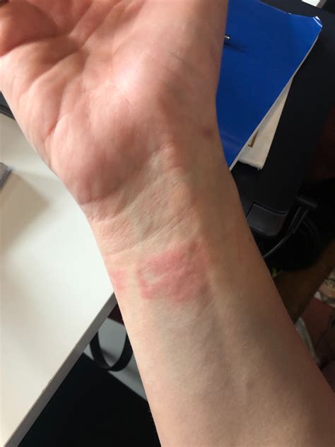 watch band allergy